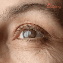 Cataract Surgery in Mexico: High-Quality Eye Care for Texas Patients